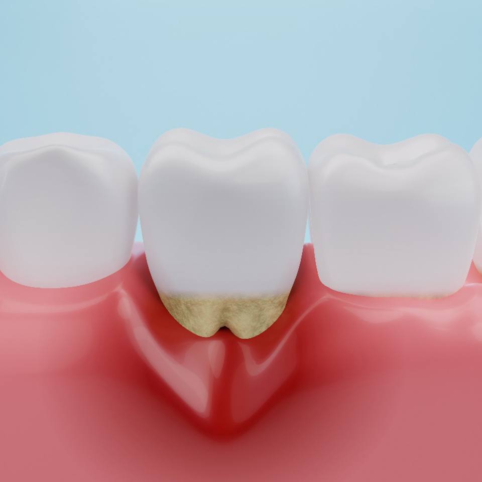 A 3D illustration of gums affected by gum disease