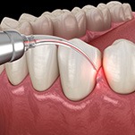 Illustration of dental laser being used on gums