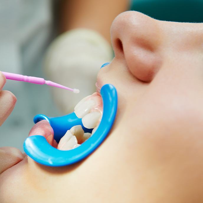 Child receiving fluoride treatment