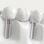 example of implant dental bridge in St. Johns