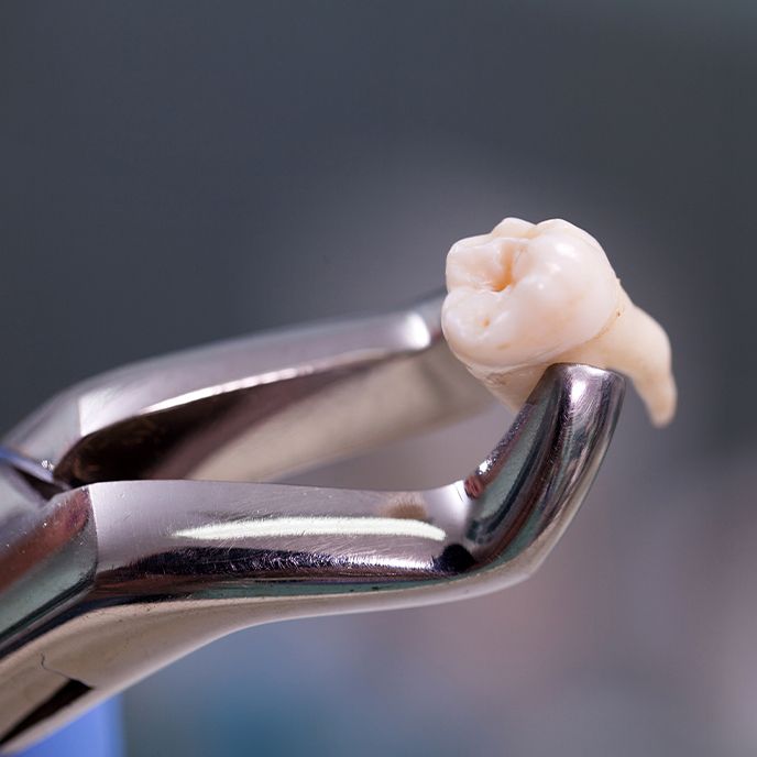 Metal clasp holding extracted tooth after oral surgery