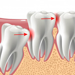 Digital image of an impacted wisdom tooth