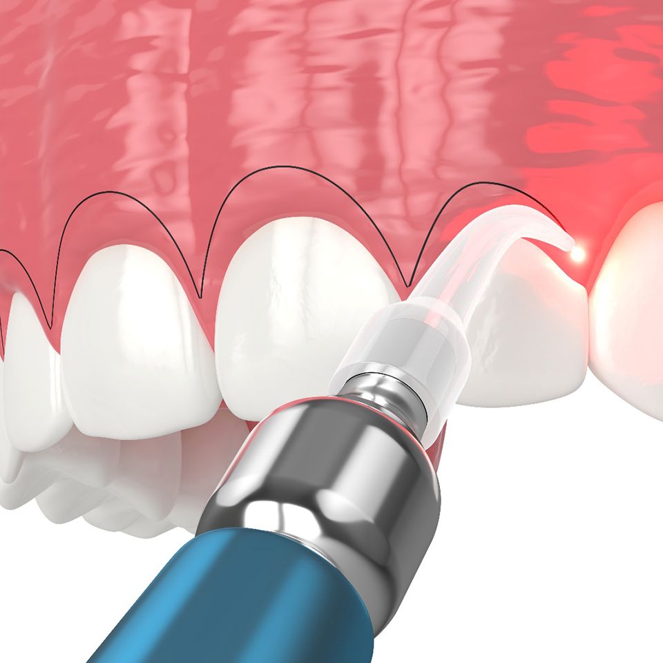 A CGI of gum recontouring