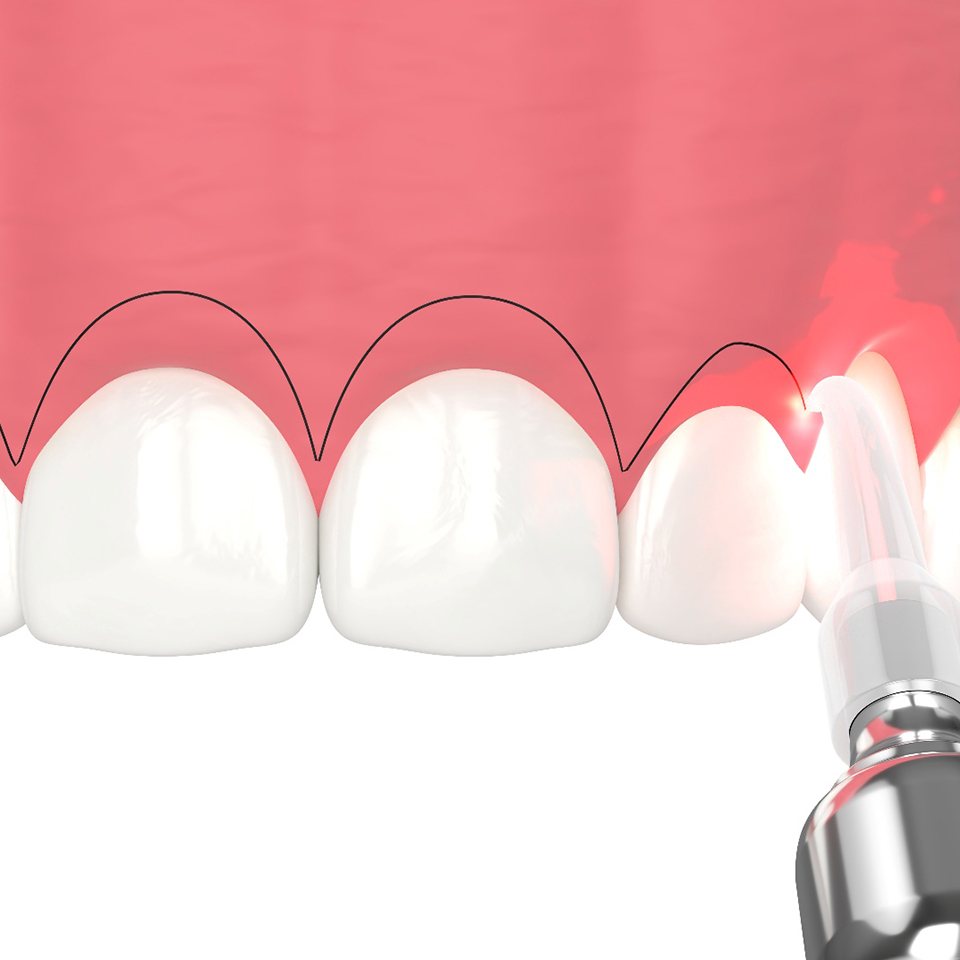 A CGI of gum recontouring with a soft tissue laser