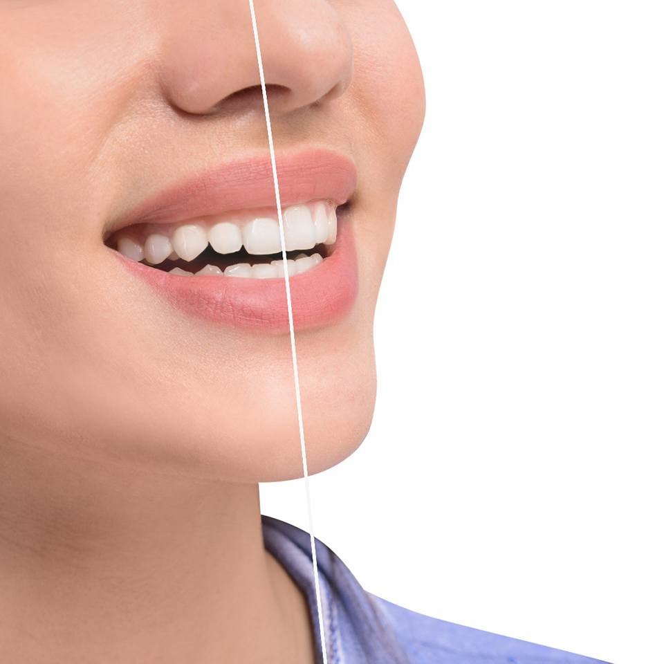 A woman before and after laser gum recontouring