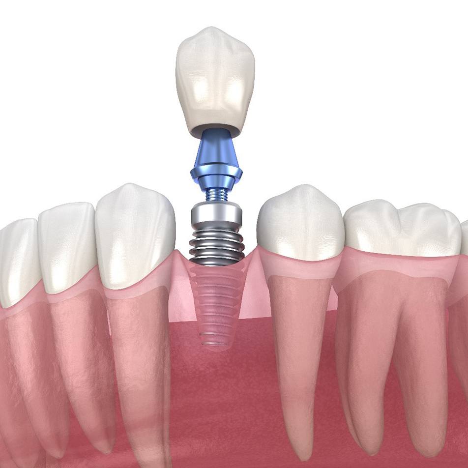 Digital image of single dental implant