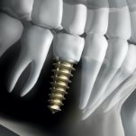 Animated smile with dental implant supported dental crown