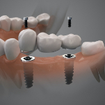 Animated smile during dental implant supported fixed bridge placement