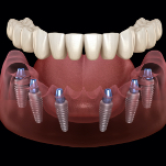 Animated dental implant supported denture placement