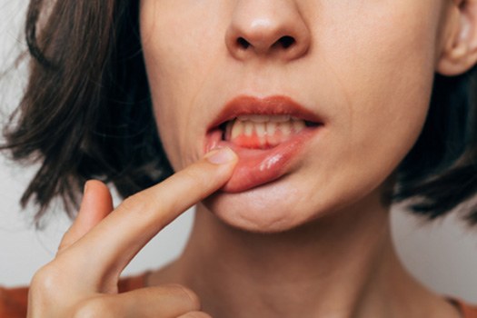 Woman with gum irritation