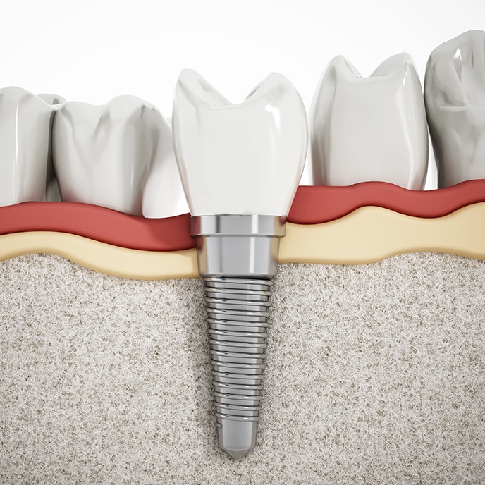 Animated dental implant supported dental crown