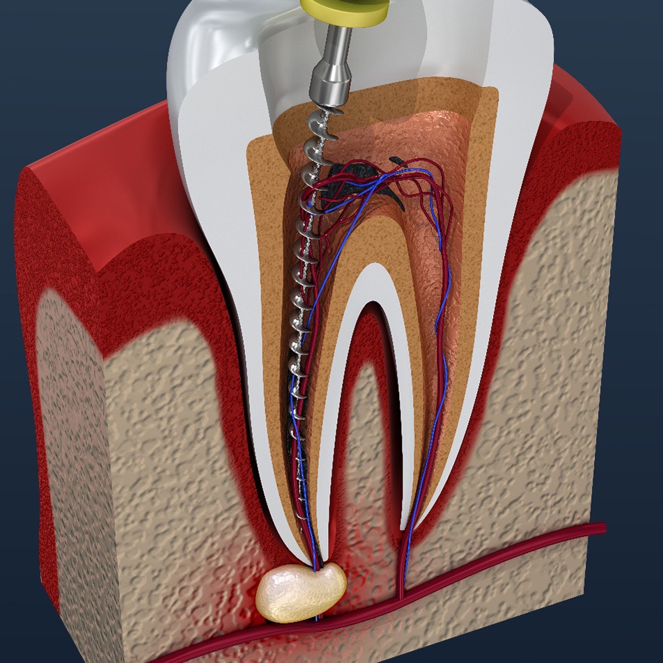 Illustration of root canal therapy in St. Johns, FL
