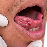 A mouth showing signs of oral cancer