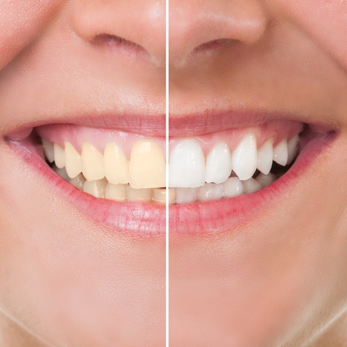 A side-by-side view of a person before and after teeth whitening in St. Johns