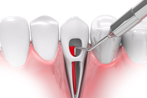 Illustration of tooth having root canal therapy performed