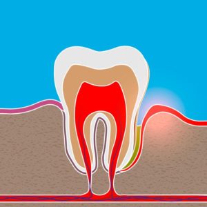 Illustration of periodontal pocket next to a tooth