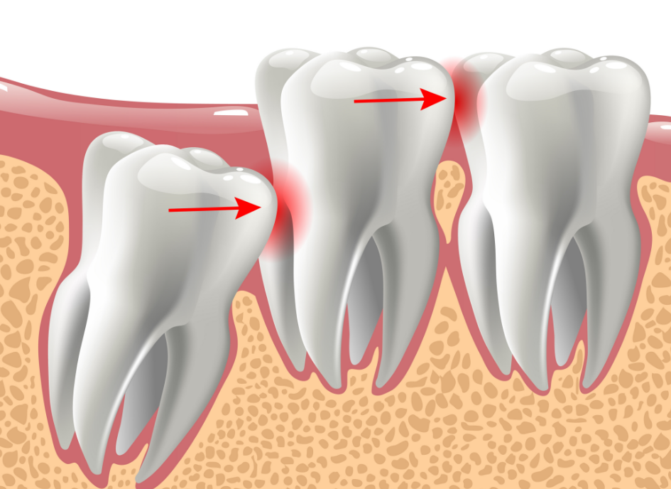 Illustration of wisdom teeth