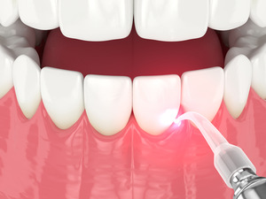 Illustration of dental laser being used to treat the gums